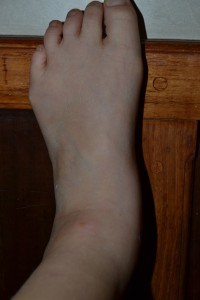 Franci's foot, swollen from the mosquito bites. Ilha Grande mosquitos are vicious! 